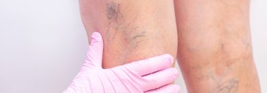 Understanding Venous Insufficiency: Causes, Symptoms, and Solutions